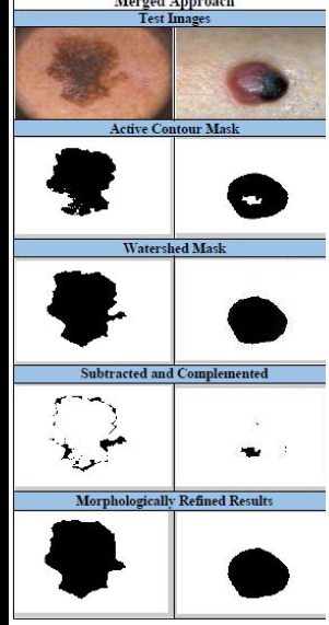 Automatic Lesion Detection
												System (ALDS) for Skin
												Cancer Classification Using
												SVM and Neural Classifiers