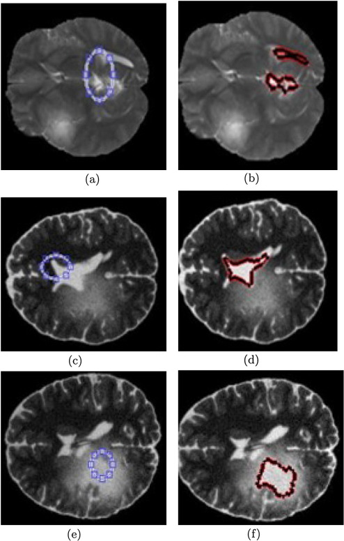 Adaptive stochastic segmentation via
											energy-convergence for brain tumor in MR images